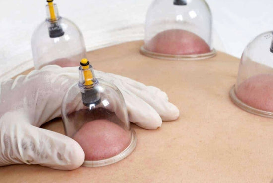 Myofascial Dry Cupping Therapy